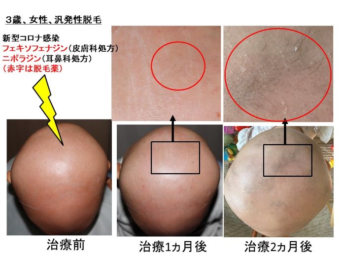 円形脱毛症　病院